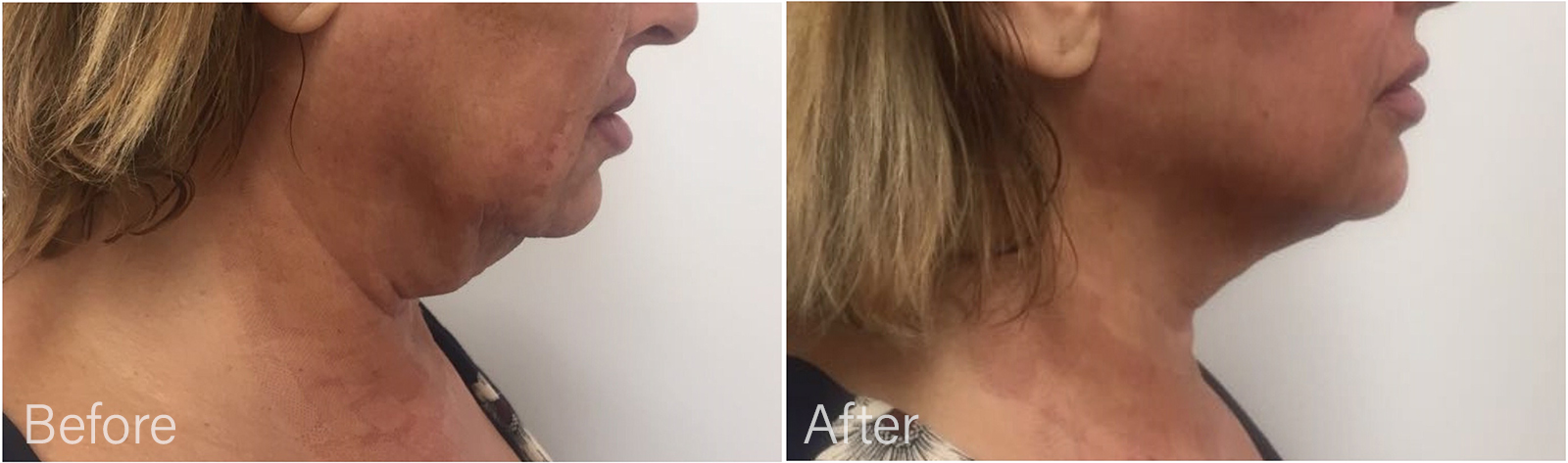 Thread Lift Virginia Beach Non Surgical Neck Lift Virginia Beach