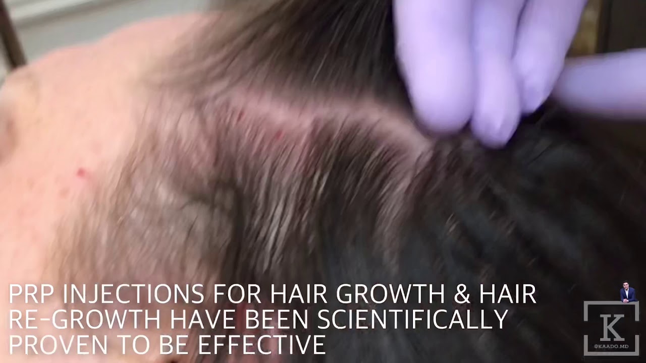 Hair Restoration Virginia Beach
