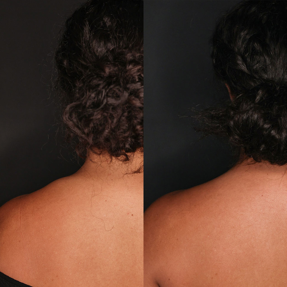 Trapezius Botox: How It Works, Before and Afters