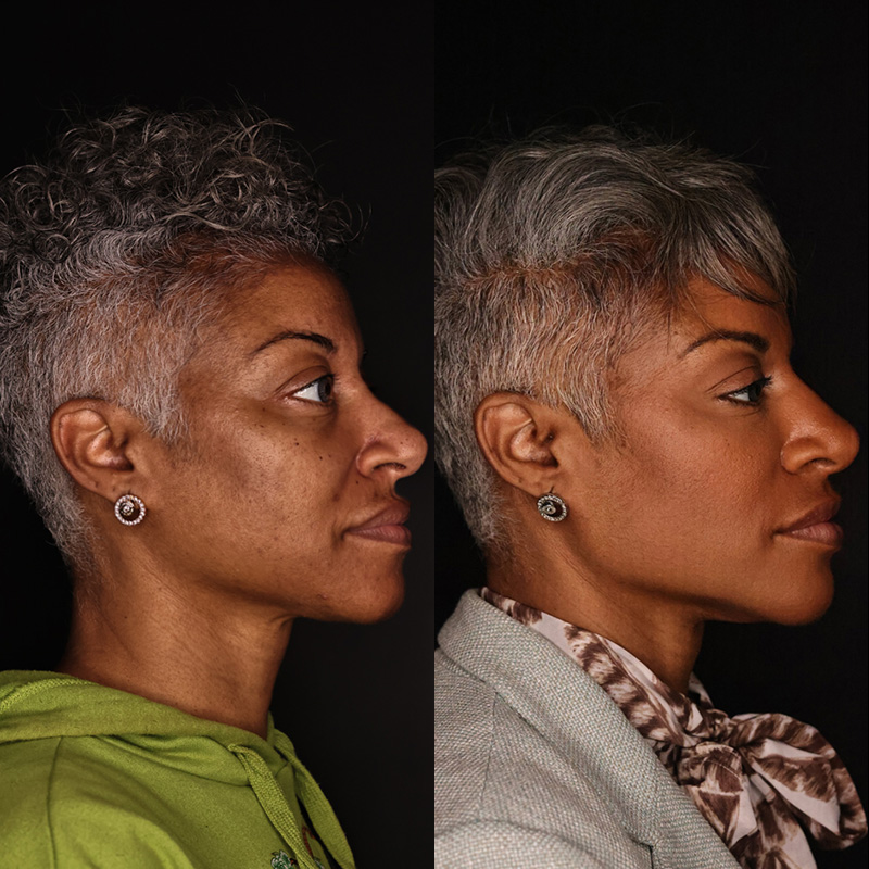 Dermal Fillers Before and After | Kaado MD Aesthetics & Anti-Aging Medicine