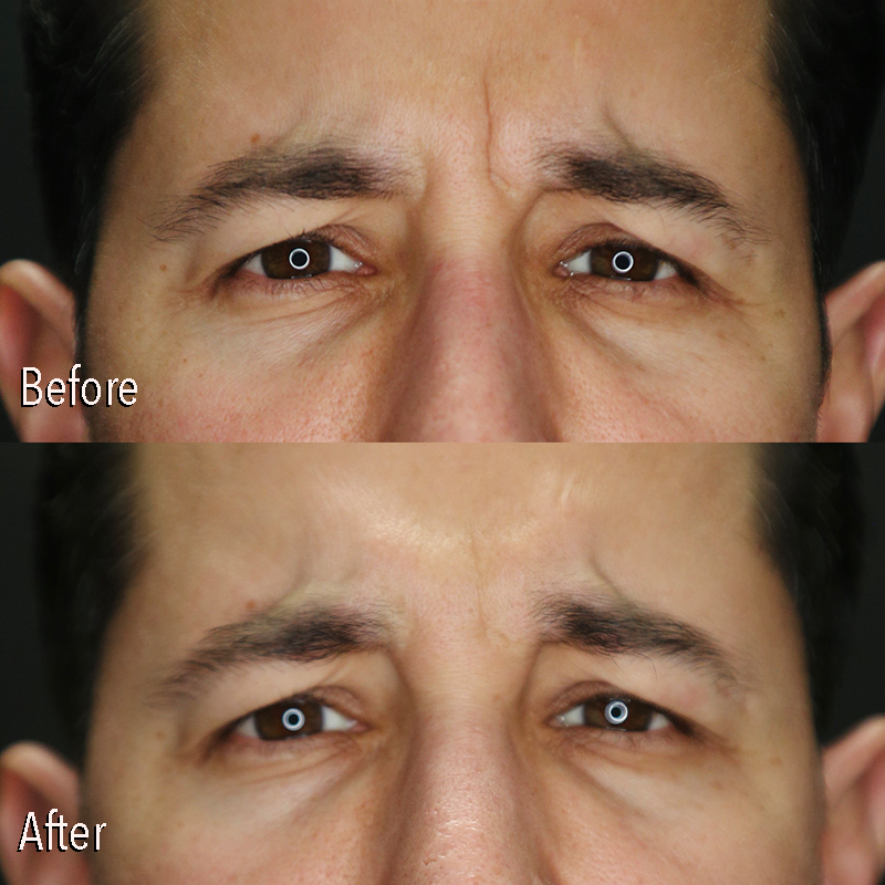 Dermal Fillers Before and After | Kaado MD Aesthetics & Anti-Aging Medicine