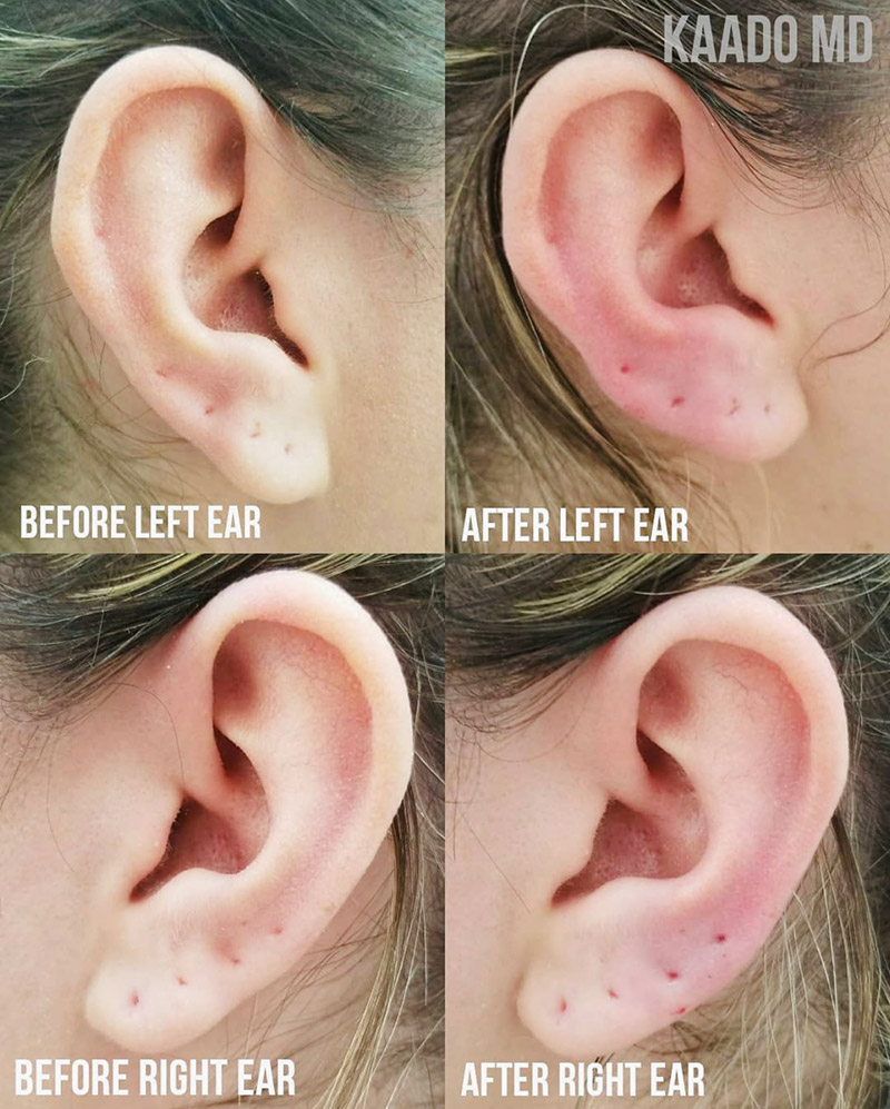 Dermal Fillers Before and After | Kaado MD Aesthetics & Anti-Aging Medicine