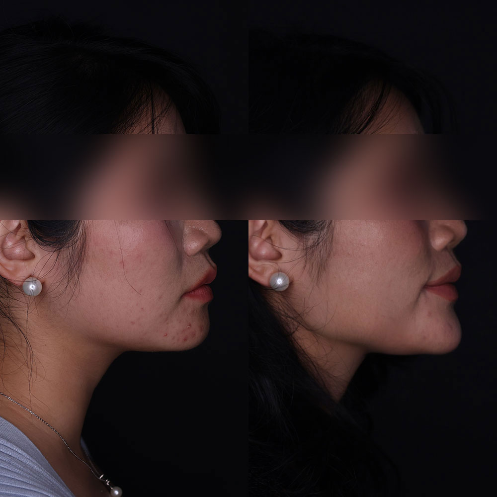 Jawline Contouring Before and After | Kaado MD Aesthetics & Anti-Aging Medicine