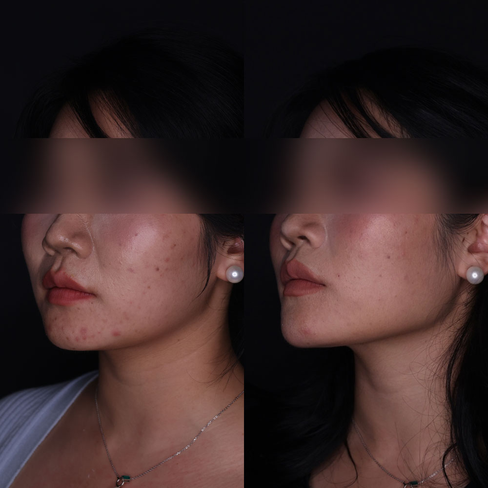 Jawline Contouring Before and After | Kaado MD Aesthetics & Anti-Aging Medicine